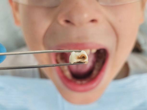 Best Emergency Tooth Extraction in Edwardsville, KS